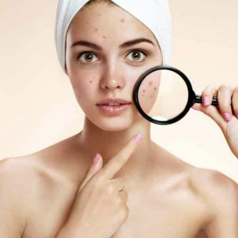 HÁBITOS QUE EMPEORAN EL ACNÉ