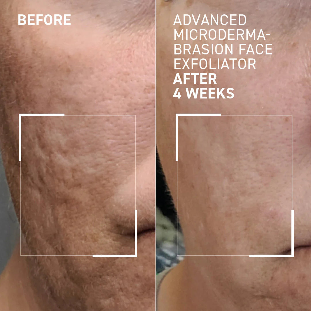 DR BRANDT Advanced Microdermabrasion Face Exfoliator