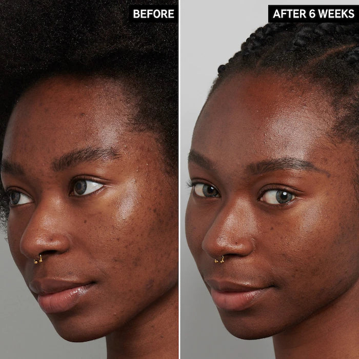 The INKEY List Tranexamic Acid Hyperpigmentation Treatment