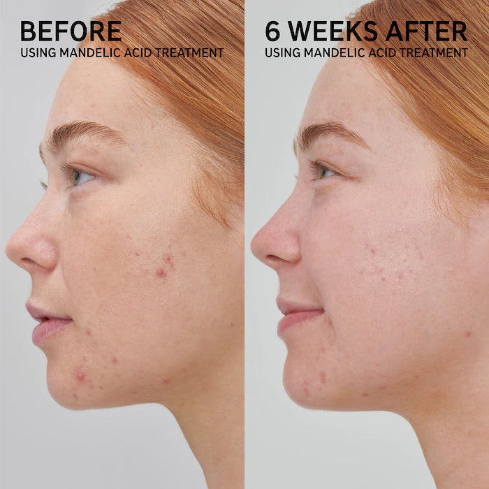 The INKEY List Mandelic Acid Treatment