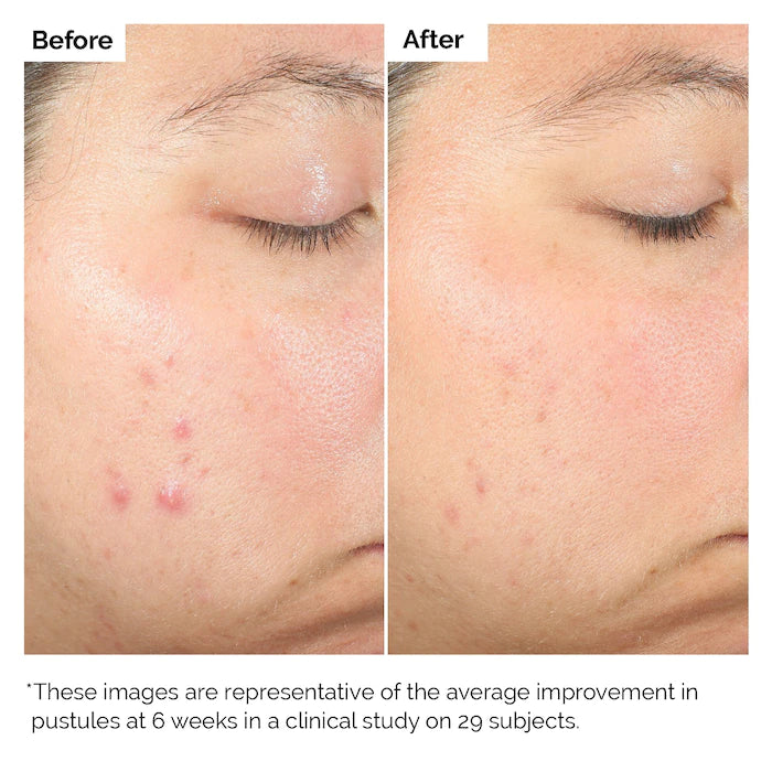 The Ordinary Salicylic Acid 2%