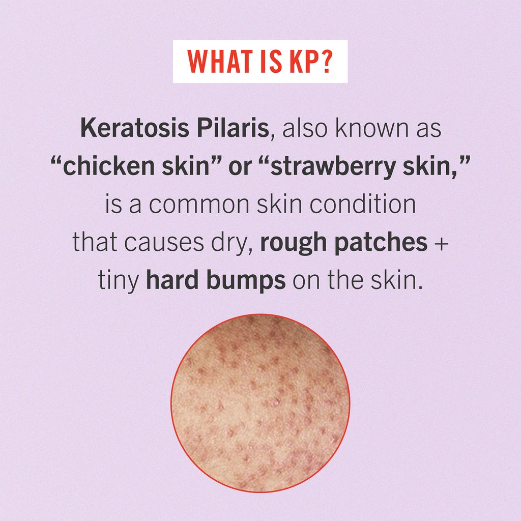 First Aid Beauty  KP Bump Eraser Body Scrub 10% AHA Fresh Strawberry 226GR