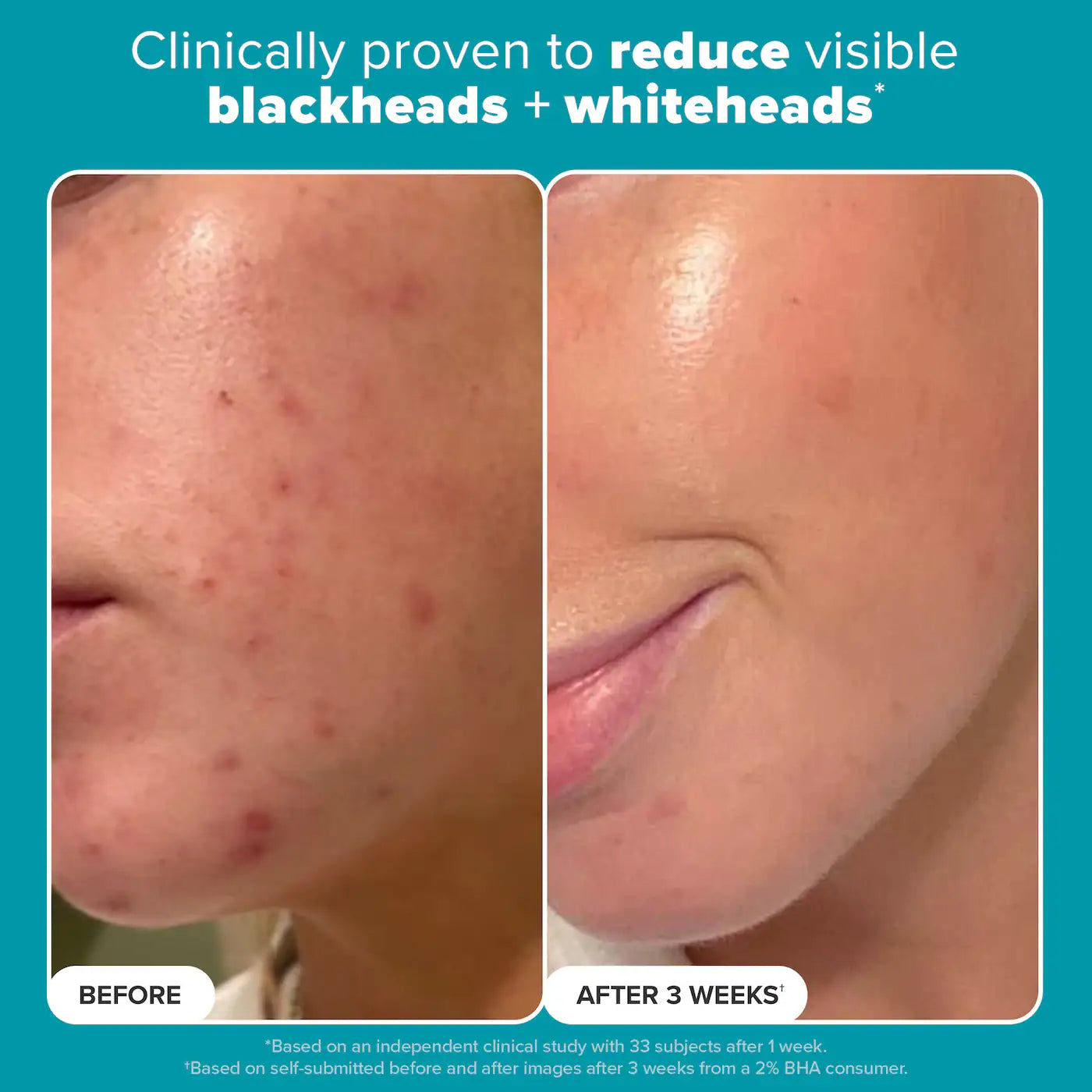 Paula's Choice Skin Perfecting 2% BHA Liquid Exfoliant