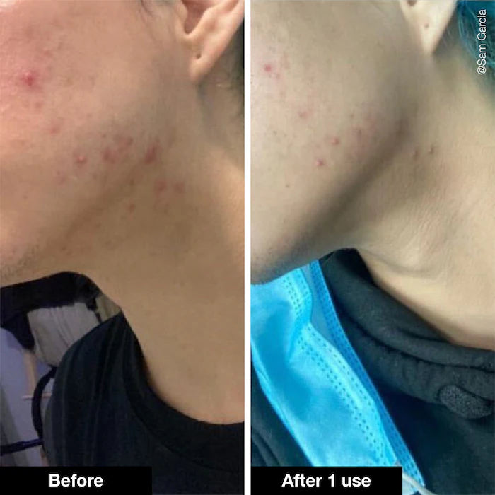 iNNBEAUTY PROJECT Pimple Paste Overnight Blemish Spot Treatment