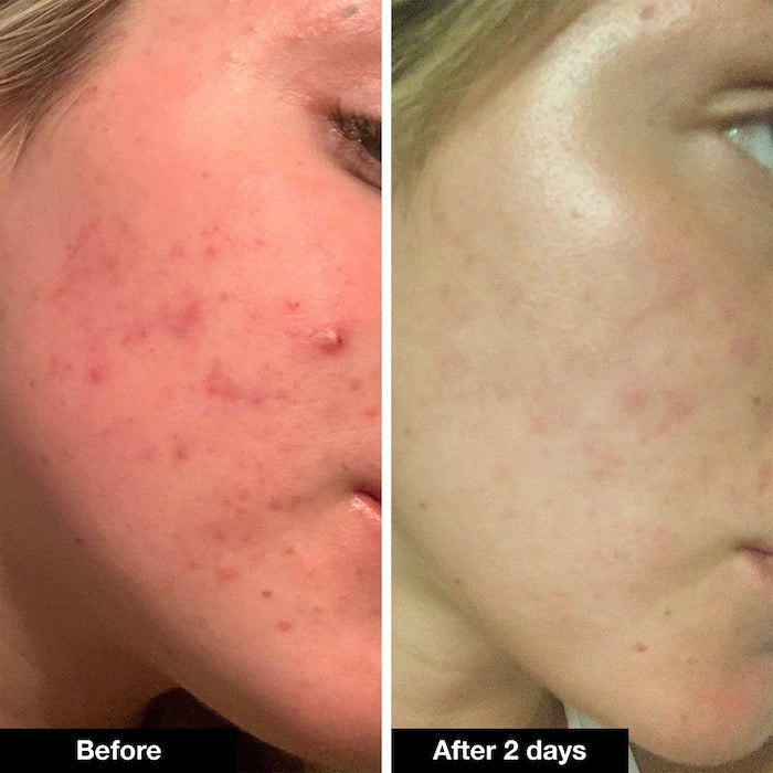 iNNBEAUTY PROJECT Pimple Paste Overnight Blemish Spot Treatment