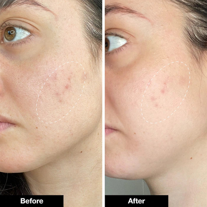 iNNBEAUTY PROJECT Pimple Paste Overnight Blemish Spot Treatment
