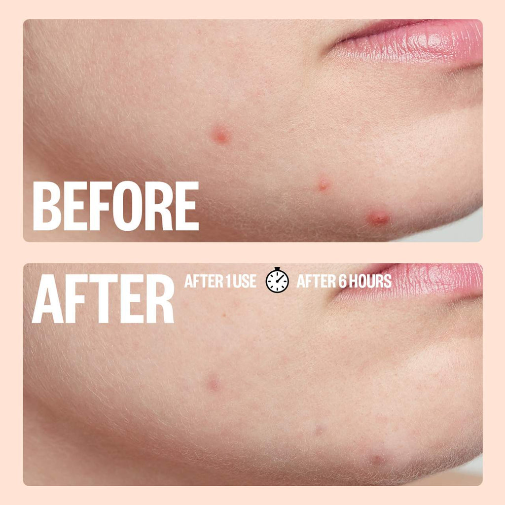 Peace Out  Salicylic Acid Acne Healing Dots