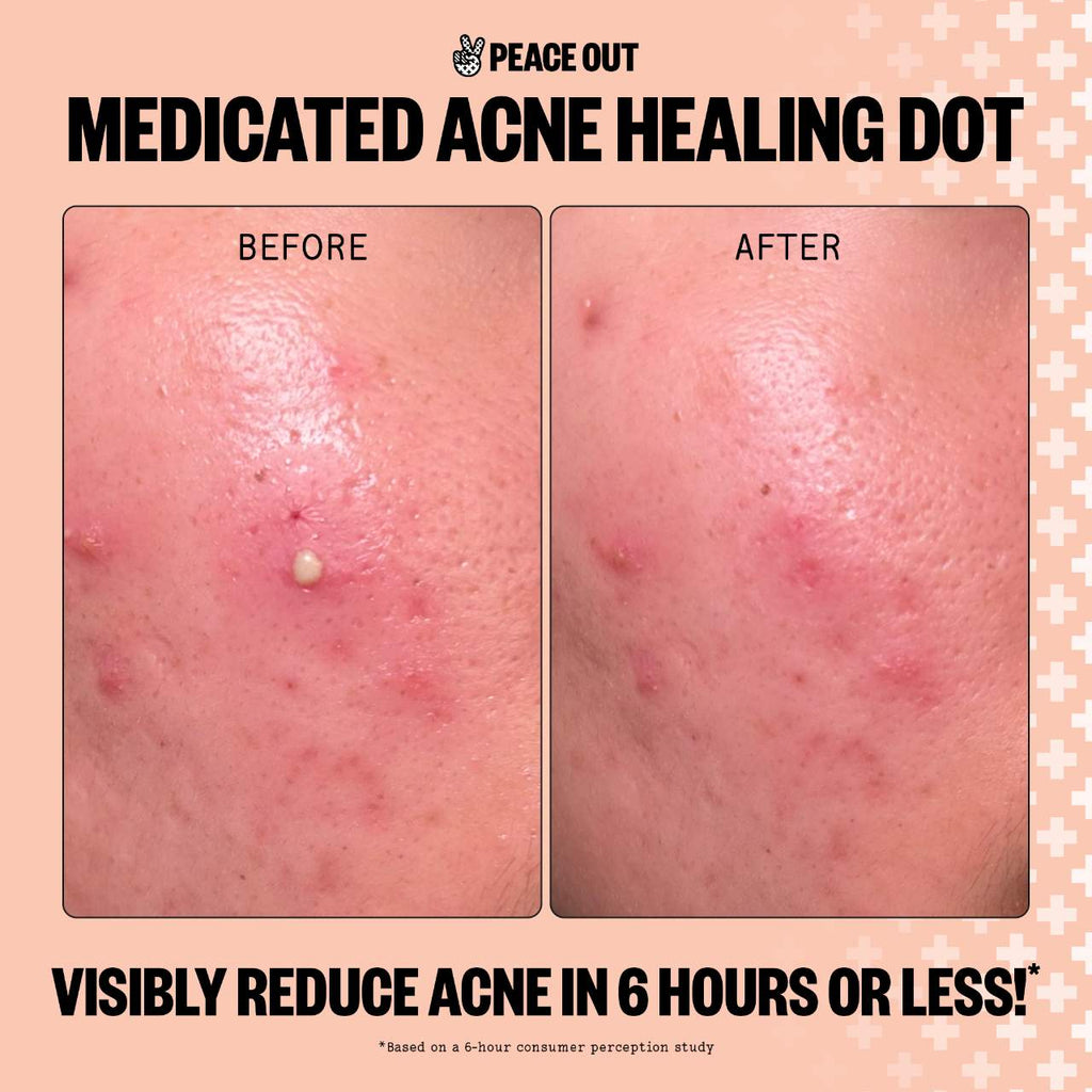 Peace Out  Salicylic Acid Acne Healing Dots
