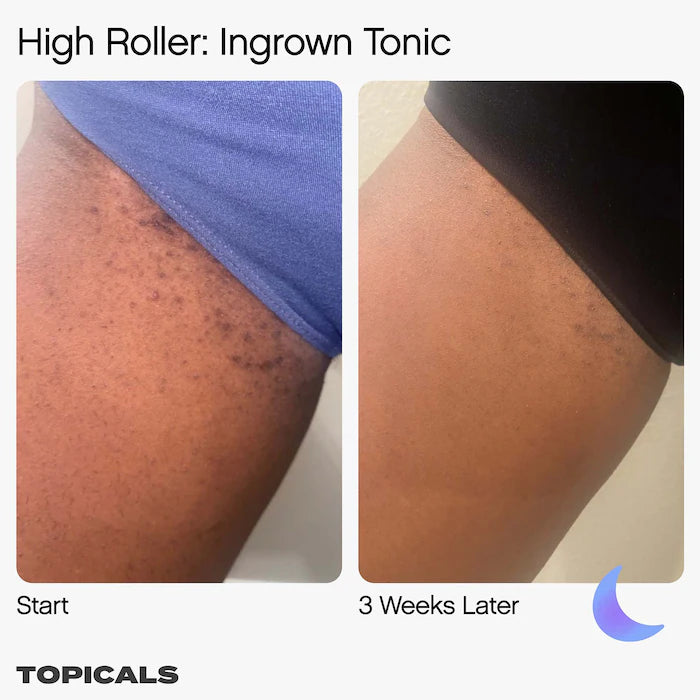 Topicals High Roller Ingrown Hair Tonic with AHA and BHA