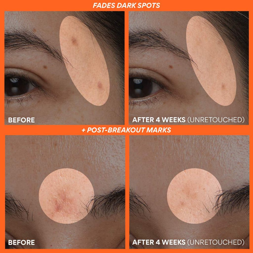 innisfree  Rapid Vitamin C Brightening Serum for Dark Spots + Post-Breakout Marks 7ml