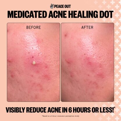 Peace Out  Salicylic Acid Acne Healing Dots - Imagen 5